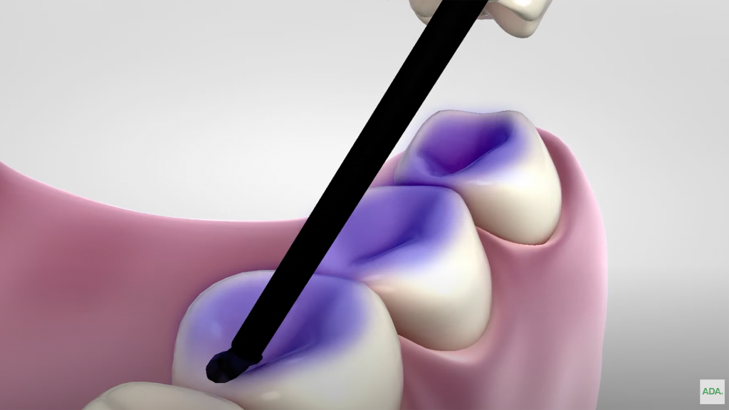 How To Seal Out Tooth Decay